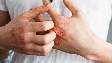 skin-disease-