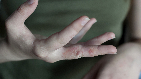 fungal infection